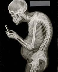 Radiografía de un hombre encorvado mirando su celular, representando los efectos del uso prolongado de dispositivos en la columna.