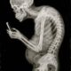 Radiografía de un hombre encorvado mirando su celular, representando los efectos del uso prolongado de dispositivos en la columna.