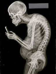 Radiografía de un hombre encorvado mirando su celular, representando los efectos del uso prolongado de dispositivos en la columna.