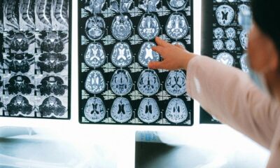 Médico señalando imágenes cerebrales en una radiografía que muestran el estudio de placas amiloides relacionadas con el Alzheimer.