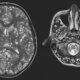 Resonancia magnética cerebral que muestra múltiples lesiones ocasionadas por neurocisticercosis, una infección parasitaria que afecta el cerebro humano.