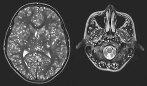 Resonancia magnética cerebral que muestra múltiples lesiones ocasionadas por neurocisticercosis, una infección parasitaria que afecta el cerebro humano.