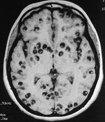 Resonancia magnética cerebral que muestra múltiples lesiones ocasionadas por neurocisticercosis, una infección parasitaria que afecta el cerebro humano.