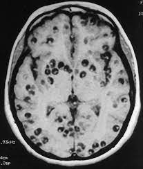 Resonancia magnética cerebral que muestra múltiples lesiones ocasionadas por neurocisticercosis, una infección parasitaria que afecta el cerebro humano.