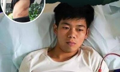 Joven recostado en cama hospitalaria tras haber vendido un riñón; imagen secundaria muestra cicatriz en el costado.