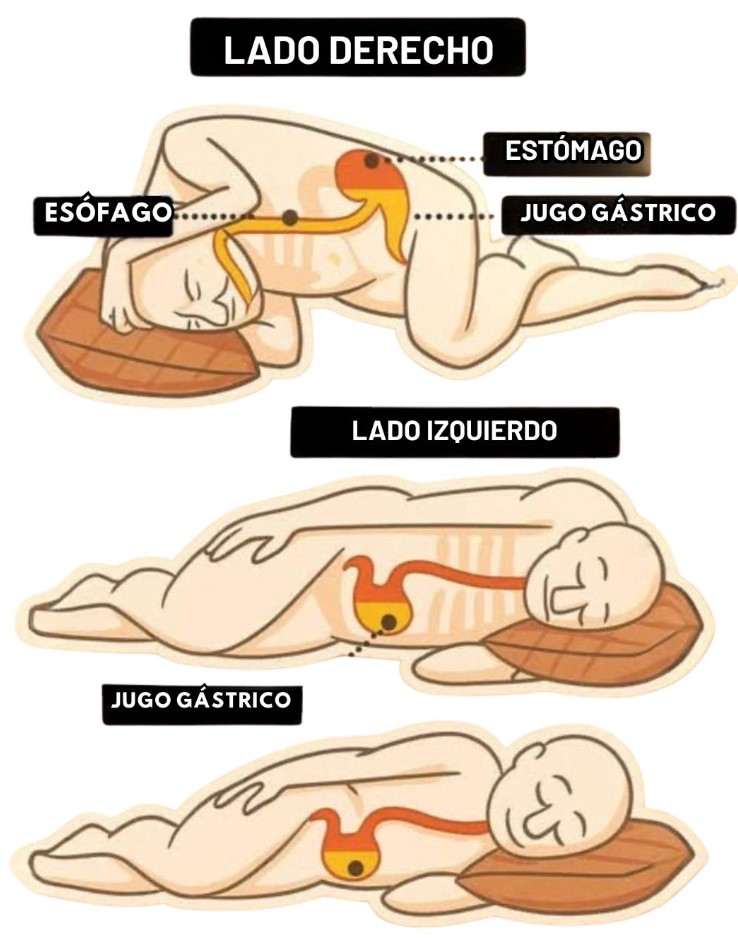 Ilustración comparativa de posiciones para dormir mostrando jugo gástrico y estómago en lado izquierdo y derecho.