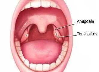 "Ilustración de una boca abierta que señala la ubicación de las amígdalas y tonsilolitos en la garganta."