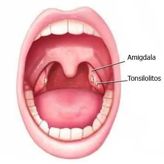 "Ilustración de una boca abierta que señala la ubicación de las amígdalas y tonsilolitos en la garganta."