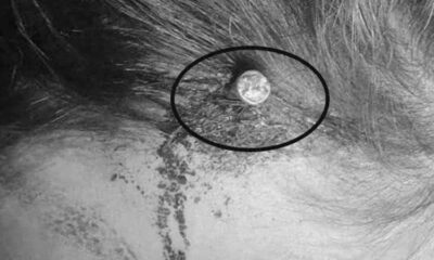 Imagen médica que documenta una práctica peligrosa derivada de creencias tradicionales en Pakistán.