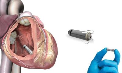 Ilustración de un marcapasos inyectable ultrapequeño colocado dentro del corazón humano.