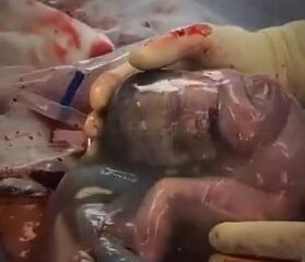 Bebé recién nacido dentro del saco amniótico en un parto en velo procedimiento médico raro