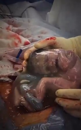 Bebé recién nacido dentro del saco amniótico en un parto en velo procedimiento médico raro