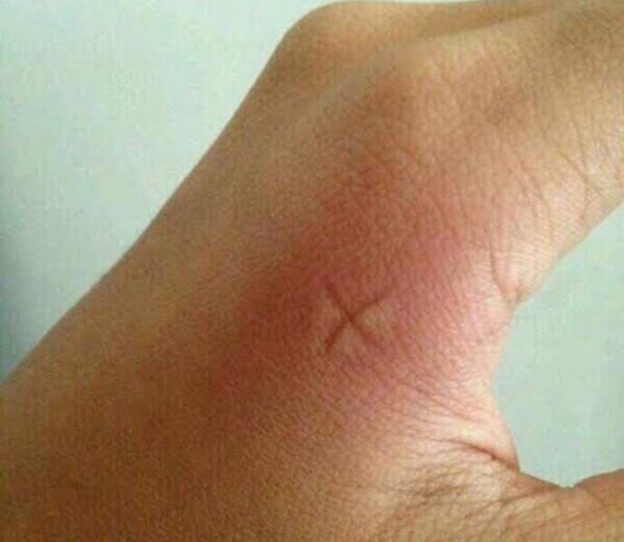 Inflamación en la piel provocada por picadura relacionada con síntomas de dengue durante la temporada de lluvias en Puebla.
