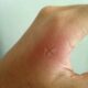 Inflamación en la piel provocada por picadura relacionada con síntomas de dengue durante la temporada de lluvias en Puebla.