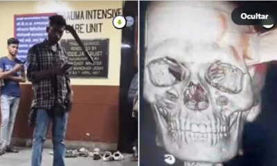 Hombre en hospital tras agresión con machete y radiografía craneal relacionada con lesión extrema