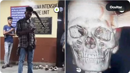 Hombre en hospital tras agresión con machete y radiografía craneal relacionada con lesión extrema